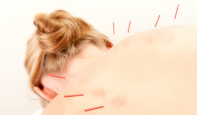 Acupuncture Patient Treatment In Back