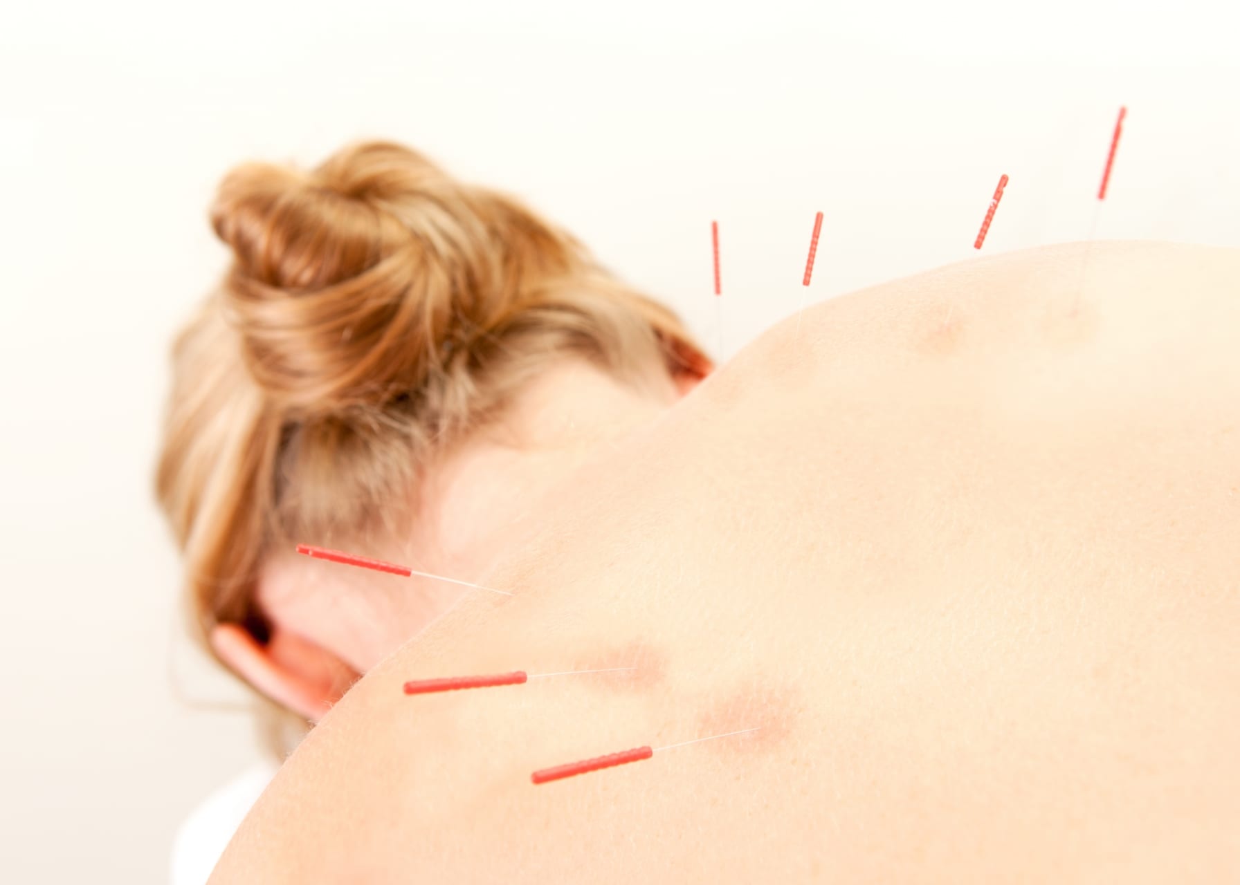 Acupuncture Patient Treatment In Back