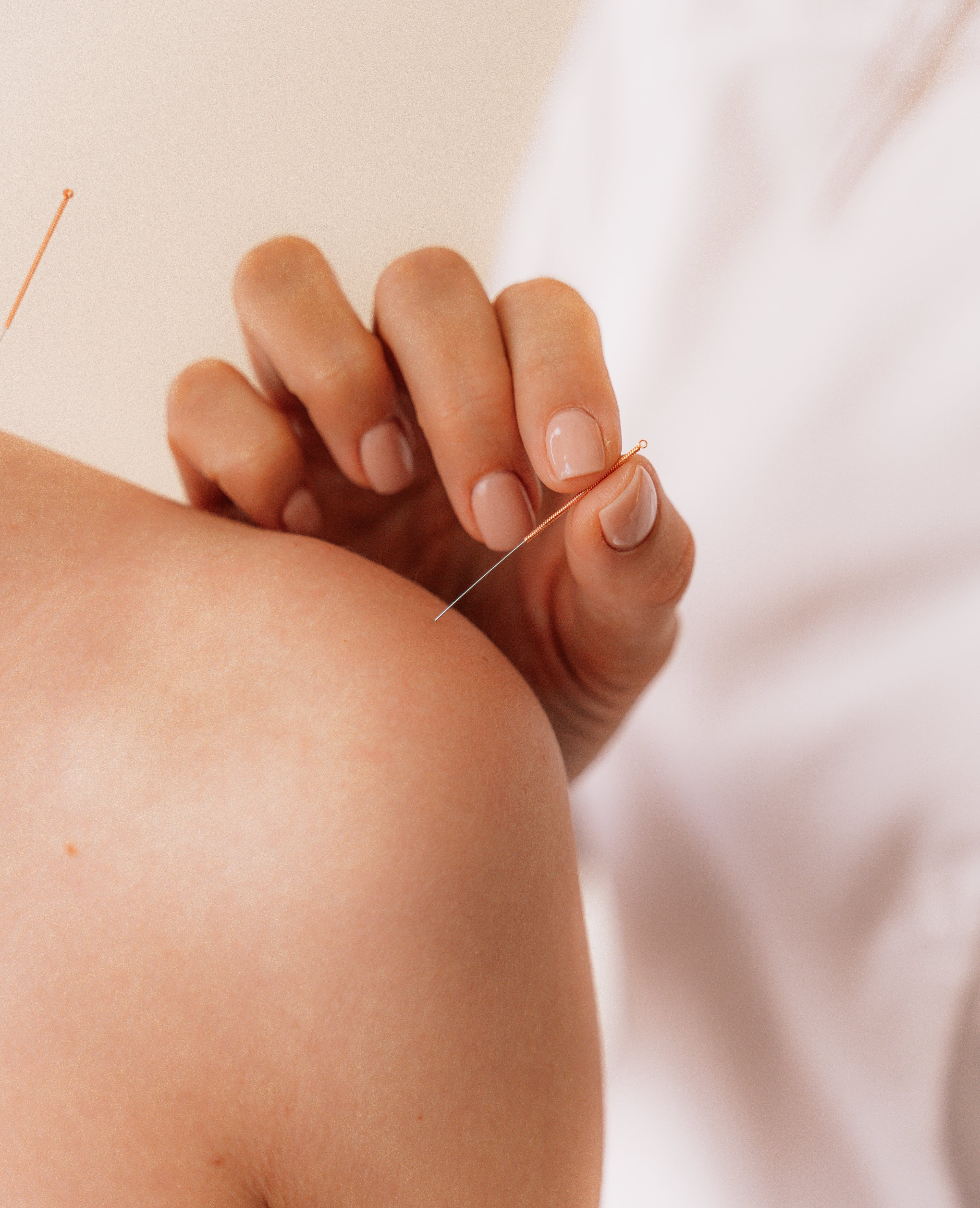 Can Acupuncture Help Anxiety